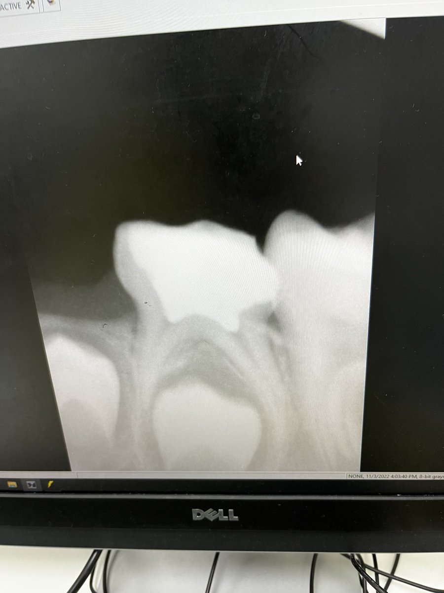 HindMM_'s tweet photo. I hope it’s my last pulpotomy 👀 https://t.co/8kJmvoJMqy