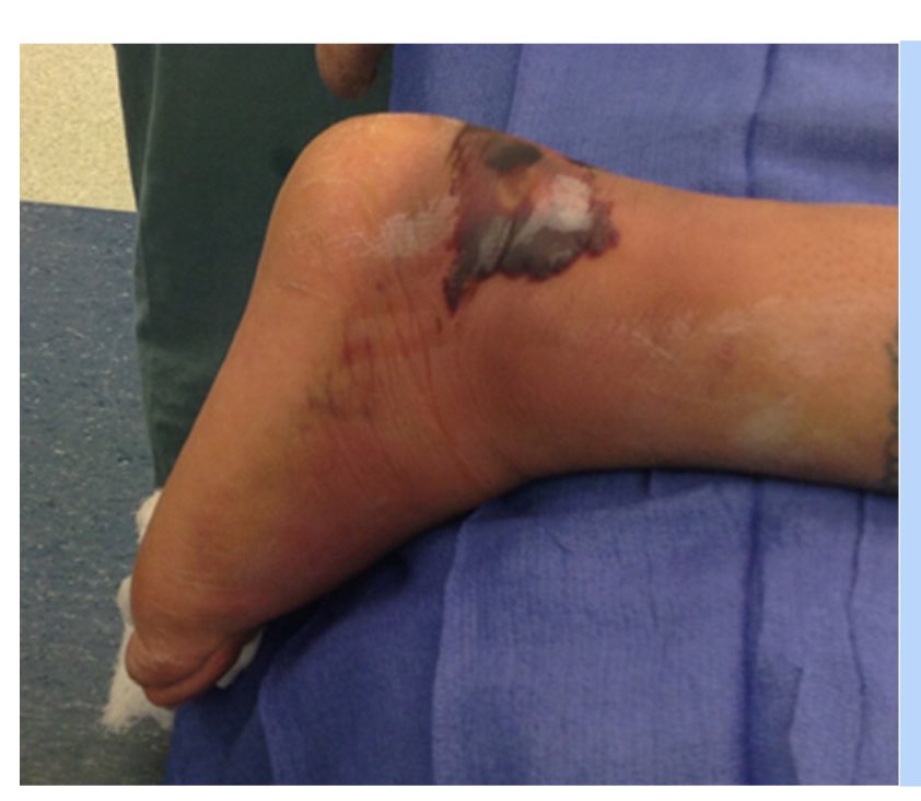 Of the answers I agree maximum plantarflexion but this is a case I take in the middle of the night. Need to take off pressure ASAP to avoid necrosis. does this injury get you out of bed? <a href="/rkh_md/">Ryan K Harrison, MD</a> @CJFooteMD <a href="/DrFraneNicholas/">Broken Bone Doc</a> <a href="/AnkleFootMotion/">Rohit Madhav</a> <a href="/pmangoneMD/">Peter G Mangone 🧢</a>
