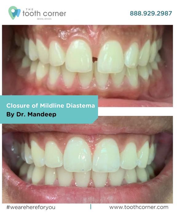 toothcorner's tweet photo. Diastema Closure by Dr. Mandeep at
At The Tooth Corner Martin Groove Etobicoke🇨🇦

#diastema #disateraclosure
#diastemas #diastemaclosurecomposite #aestheticdentistry https://t.co/2wPsHCwwYo