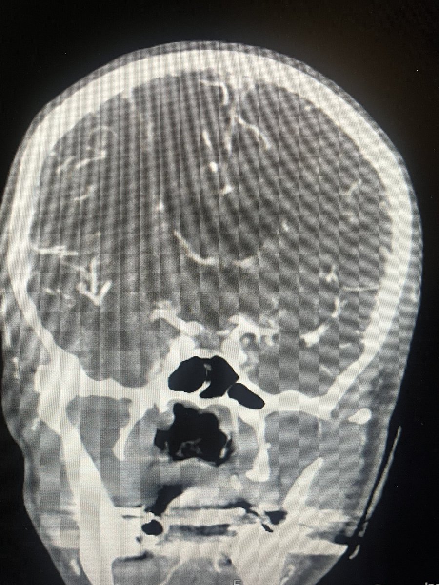rosegoldneuro's tweet photo. When your brain has a #arrowsign before the #radiologists can get to it ⬇️ @leilagachechil1 https://t.co/nOAu4Uum1L