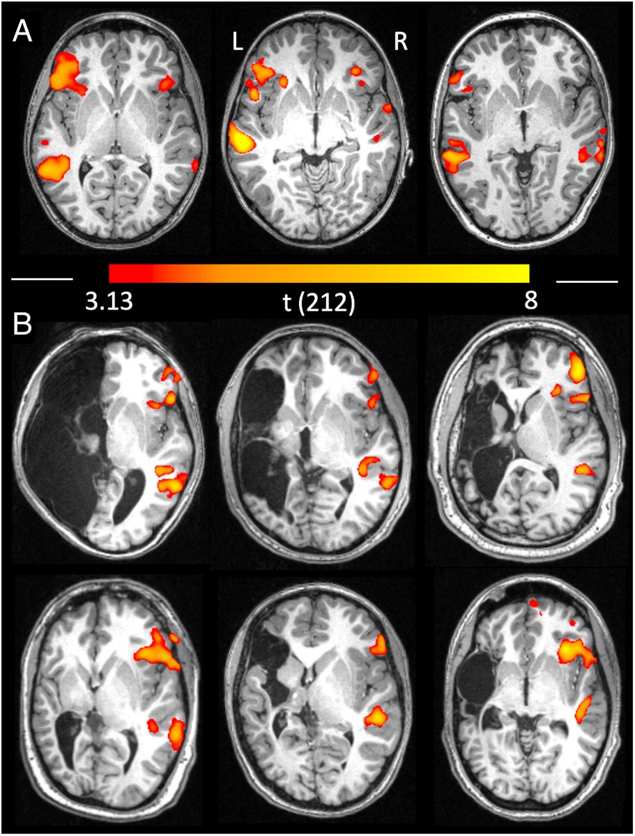 Recent findings from <a href="/Georgetown/">Georgetown University</a> University reveal that infants who experience a left-sided stroke during birth adapt their brain development to process language in the right side of the brain. Learn more on our blog: dornsife.usc.edu/labs/baby-lab/…