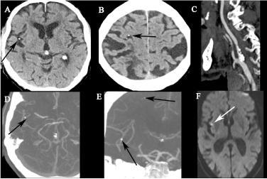 TKG_Radiology's tweet image. 石灰化脳塞栓(calcified cerebral embolism)

・石灰化塞栓子による脳梗塞
・塞栓源:大動脈弁/僧帽弁石灰化,頸動脈/大動脈弓部等のアテローム性動脈硬化
・塞栓先:中大脳動脈が最多
・石灰化塞栓:1-5.5mm,円形-卵円形
・再発リスクは43-75%と高い(診断と塞栓源指摘は重要)

#Rdiag