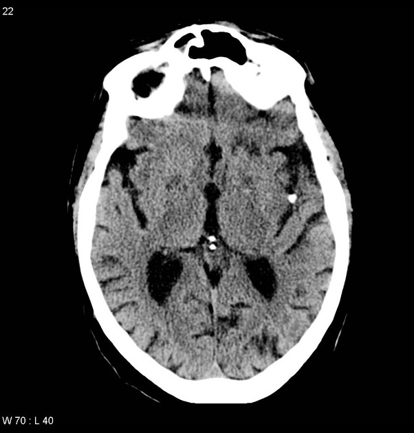 TKG_Radiology's tweet image. 石灰化脳塞栓(calcified cerebral embolism)

・石灰化塞栓子による脳梗塞
・塞栓源:大動脈弁/僧帽弁石灰化,頸動脈/大動脈弓部等のアテローム性動脈硬化
・塞栓先:中大脳動脈が最多
・石灰化塞栓:1-5.5mm,円形-卵円形
・再発リスクは43-75%と高い(診断と塞栓源指摘は重要)

#Rdiag