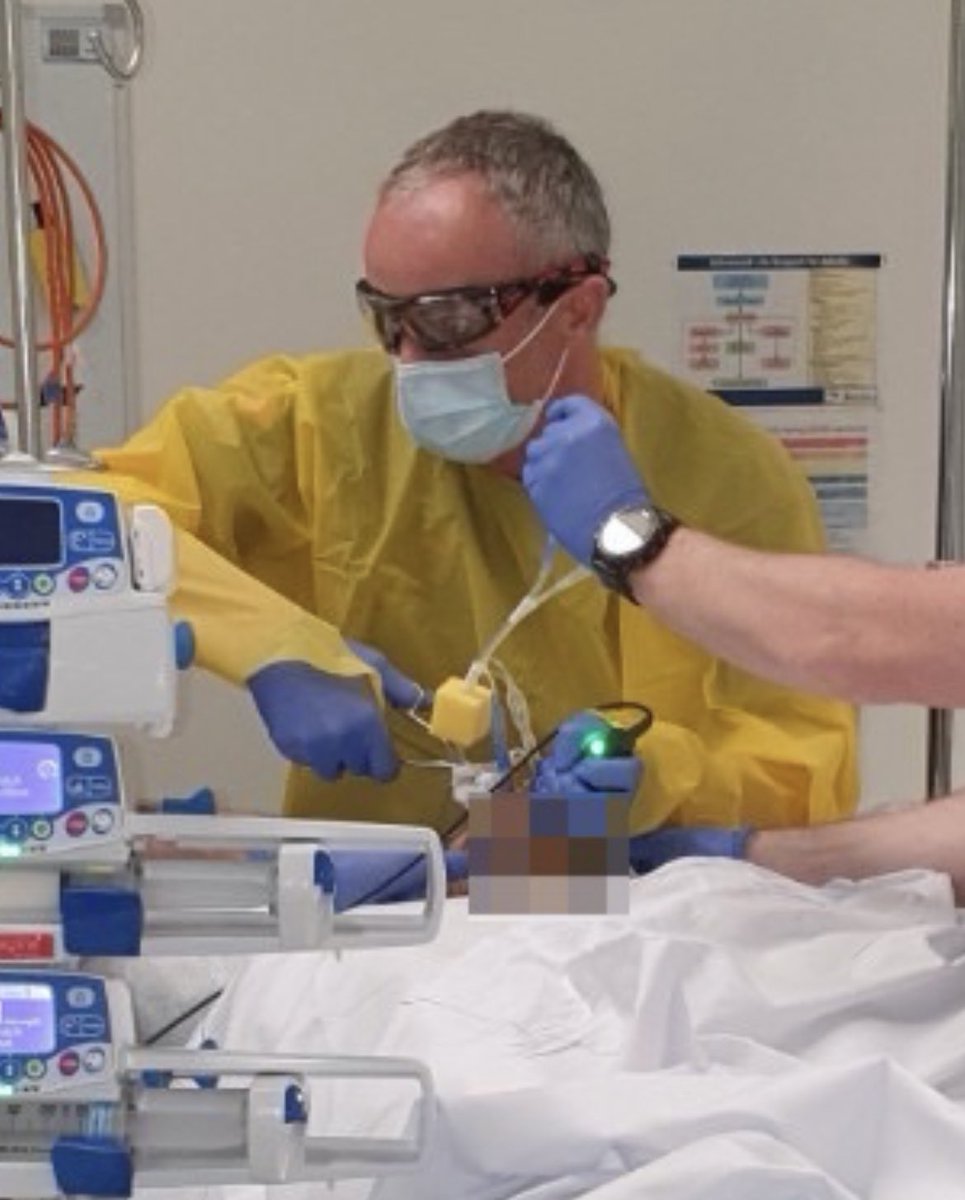cliffreid's tweet photo. Tips for inserting balloon tamponade device (eg. Sengstaken) in ED or retrieval setting (ie pre-transport)
1. Videolaryngoscopy assisted insertion
2. Store a simple Quick Reference Guide with the device (like this one by @PeteLawrance2 )
3. Tape to a collar to provide traction https://t.co/EISYTIM3YW