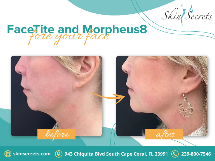 skinsecrets6's tweet photo. Time after time, FaceTite® and Morpheus8 give women and men the younger look they want.
#inmode #facetite #embracerf #inmodeembracerf #facecontour #minimallyinvasive #radiofrequency #facetreatment #facialtreatment #tightenskin #facecontouring #dissolvefat #chintreatment https://t.co/cfID9slFRO