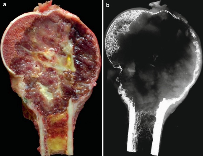 JOrthopedics's tweet photo. A Case Report of a #Sacral #Giant #Cell #Tumor #Treated With Block Resection and #Lumbo-Pelvic Fixation https://t.co/6cgelgUEk9
GCT are benign but locally aggressive neoplasms composed of osteoclast-like giant cells and fusiform to ovoid mononuclear stromal cells.
#joo
#Article https://t.co/i0PKpQGBrd
