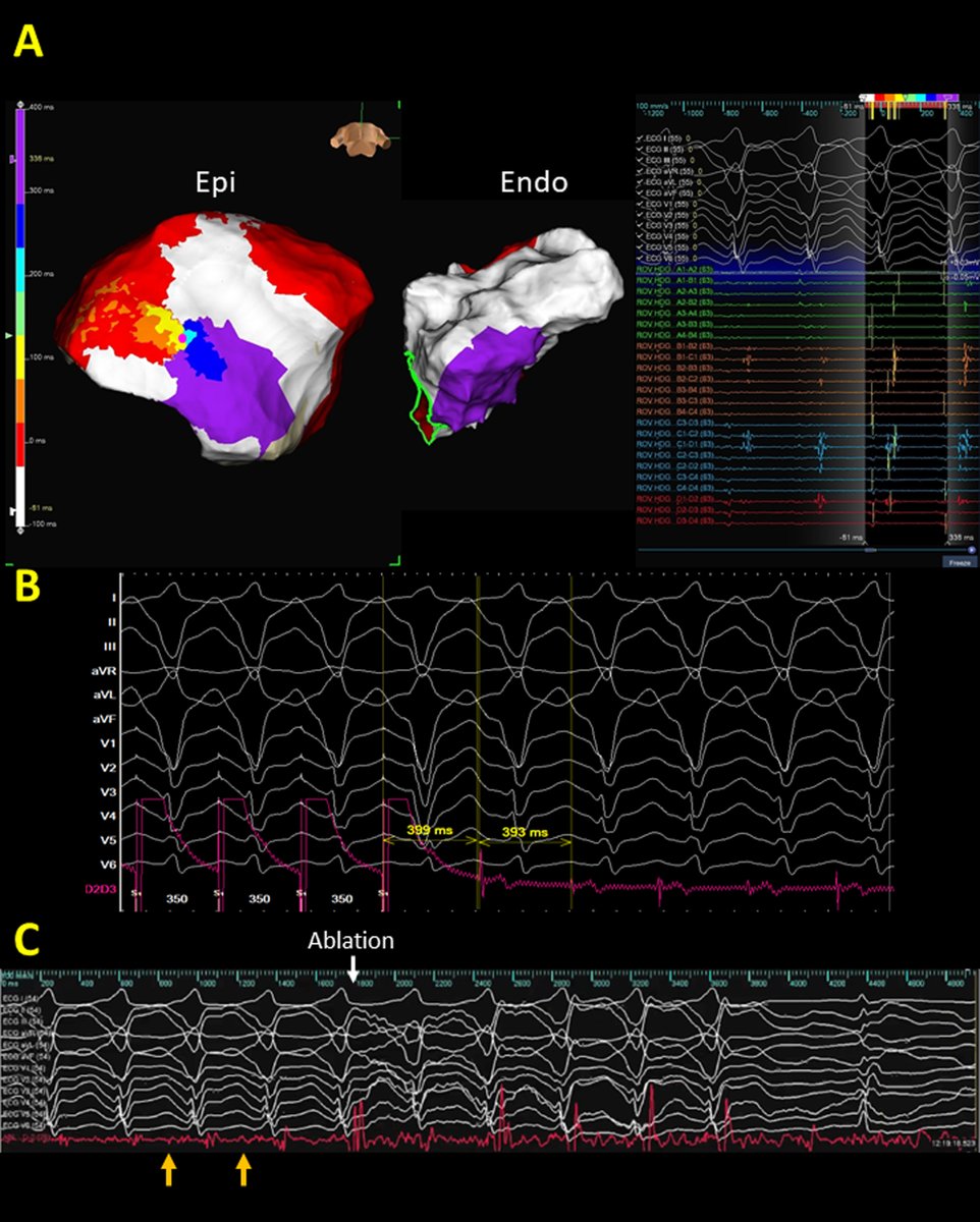 RCMjournal's tweet photo. #RCM - Vol. 22 No. 4
#Callforread
💌Review - Arrhythmogenic right ventricular cardiomyopathy: diverse substrate characteristics and ablation outcome
@LinYenn @SPAF_tfchao @ChinYuLin4 @ChihMinL @huei_liu
#ARVC #ICD #SCD #ablation #VT #VF
Full text:
https://t.co/i2Mn3JW5AU https://t.co/eYfwKna4oe