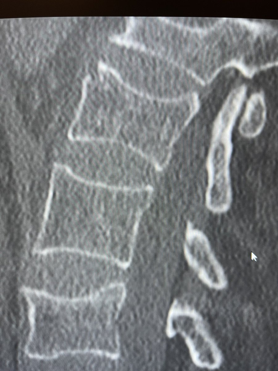 darthglader's tweet photo. Man in his 70s with a #CompressionFracture after a fall. Not an MRI candidate, so we did a CT.
• #unipedicular approach
• #EpiduralBlock for pain control
• good fill of the #FractureLine
• 20 minute case time!
• @Medtronic_Spine #KyphonVUE
@Crocs in #SportMode! https://t.co/pDPJpRhrqq