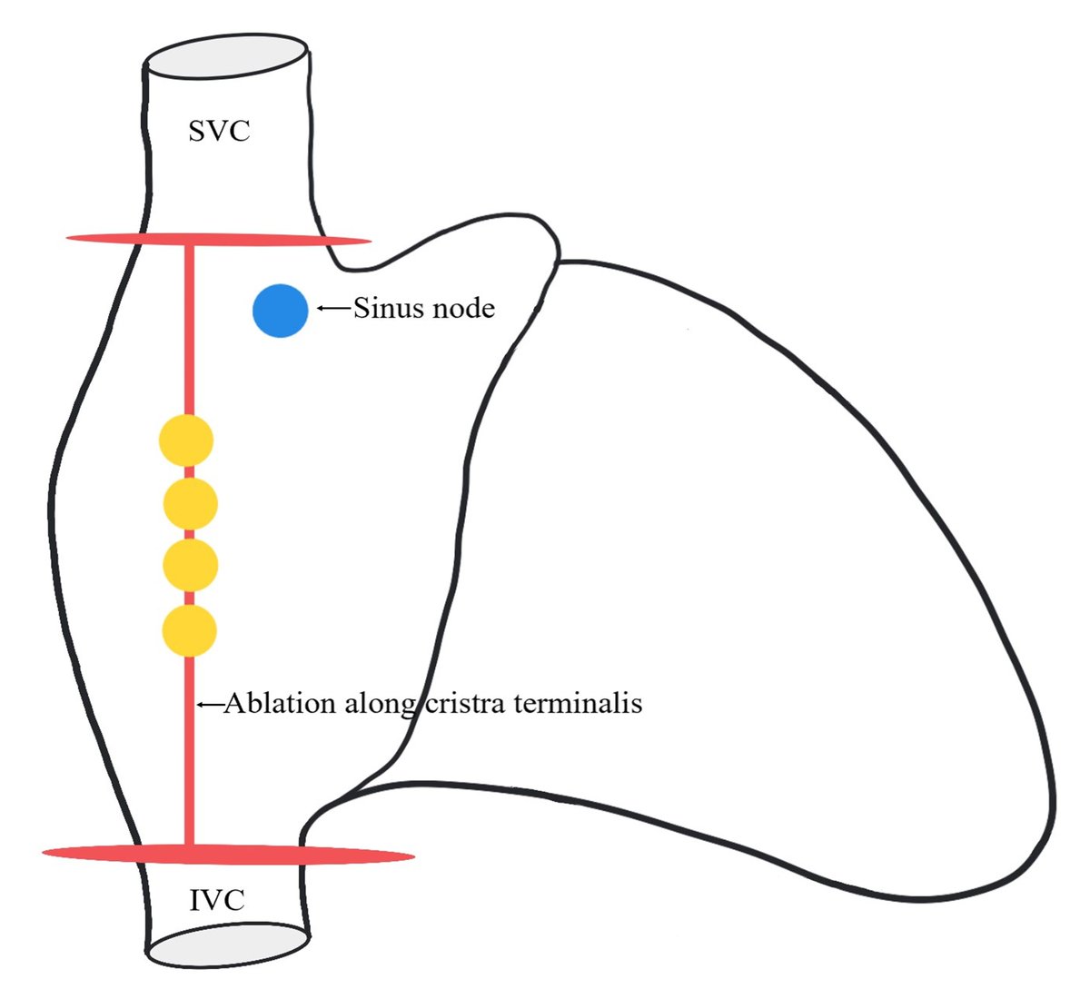 RCMjournal's tweet image. #RCM - Vol. 22 No. 4
#Callforread 
☎️Review - Inappropriate sinus tachycardia: a review
@Asimkichloo @KKanjwal 

#InappropriateSinusTachycardia #IST

Full text:
imrpress.com/journal/RCM/22…