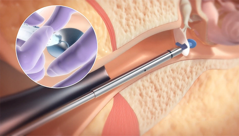 SulisTechnology's tweet photo. In-Office Pediatric Ear Tube Procedures: Interview with Preceptis Medical’s Greg Mielke4

Preceptis Medical, a medtech company based in Minnesota, created the Hummingbird Tympanostomy Tube System. The device allows ear, nose, and throat (ENT) surgeo…
https://t.co/rCGEkoCvLk https://t.co/UCZmbGomVz