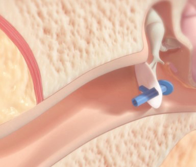 SulisTechnology's tweet photo. In-Office Pediatric Ear Tube Procedures: Interview with Preceptis Medical’s Greg Mielke4

Preceptis Medical, a medtech company based in Minnesota, created the Hummingbird Tympanostomy Tube System. The device allows ear, nose, and throat (ENT) surgeo…
https://t.co/rCGEkoCvLk https://t.co/UCZmbGomVz