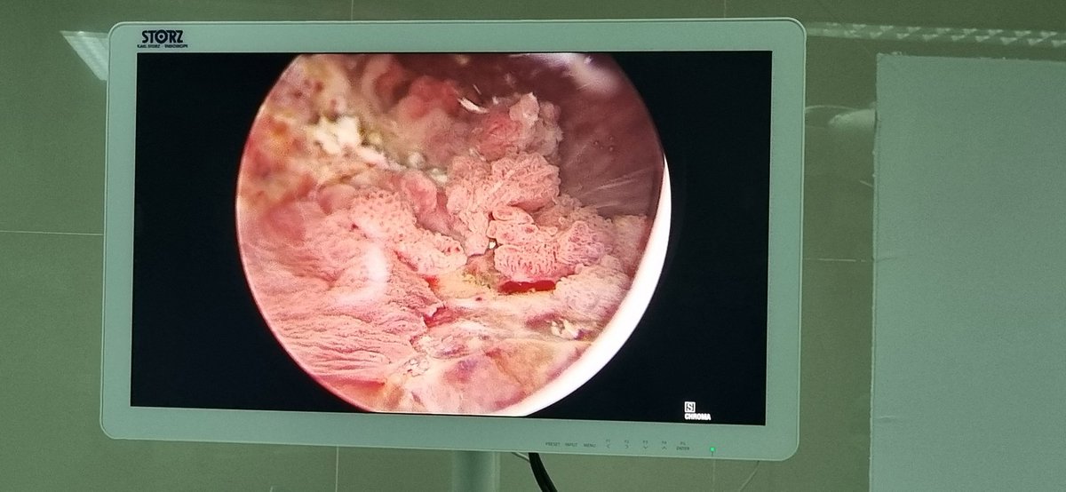 Bismillaah...
Usulan Menkeu Ibu Sri Mulyani utk menaikkan cukai rokok tidak bs untuk tidak saya dukung..
Bagaimana tidak? Hampir 90 %  pasien saya dengan kanker kandung kemih pasti merokok.
Dan itu tdk hanya di Lombok. Hampir d setiap kota di Indonesia kasus kanker kandung kemih