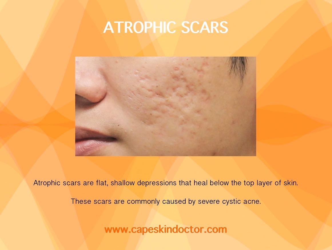 CapeSkinDoctor's tweet photo. The scars that acne can leave behind can be frustrating. There is no one best treatment for acne scarring. Treatment can improve scars and make them less noticeable. It requires multiple treatments. It's not a one-time thing. #chemicalpeels #microneedling #dermalfillers #lasers https://t.co/0pTPUgwtF9