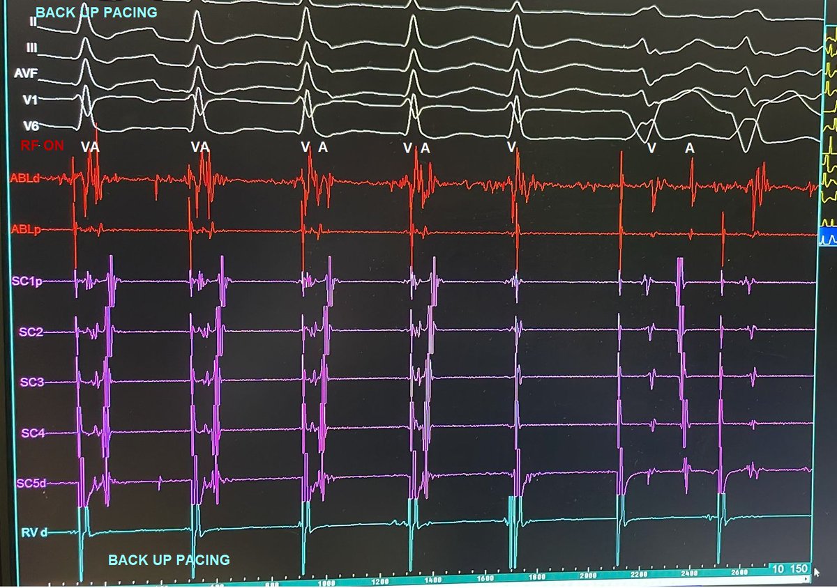 JFPortales70's tweet photo. Classical EP. Orthodromic Tachy. Ablation with backup pacing to avoid catheter dislodgement in the worst moment. I love my EPTRACER ablation signal while RF ON. You can feel the accesory pathway dying.#EPeeps #epconnect https://t.co/FabaeQvmPZ