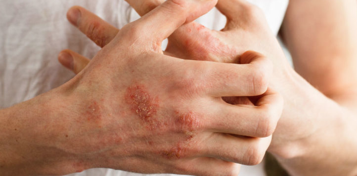 solutionscareuk's tweet photo. #Eczema linked to increased symptom severity in children with autism spectrum disorder

“There is an interesting overlap between eczema and neurodevelopmental conditions that warrants further investigation,” said study author Adam Guastella https://t.co/LY6Kg5C2hJ https://t.co/NP6oDBOOon