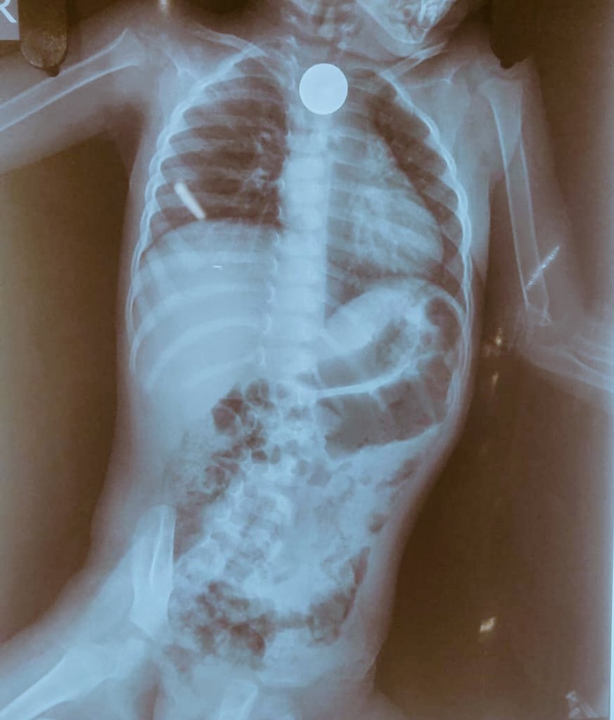 Shubhra_011's tweet photo. Foreign body and Children 🤝
▪️Coin in Esophagus or Coin in Trachea ?
▪️Which view on the radiograph helps you confirm your diagnosis ?!?
#MedTwitter
#medtrivia https://t.co/o2q9x0ODnr