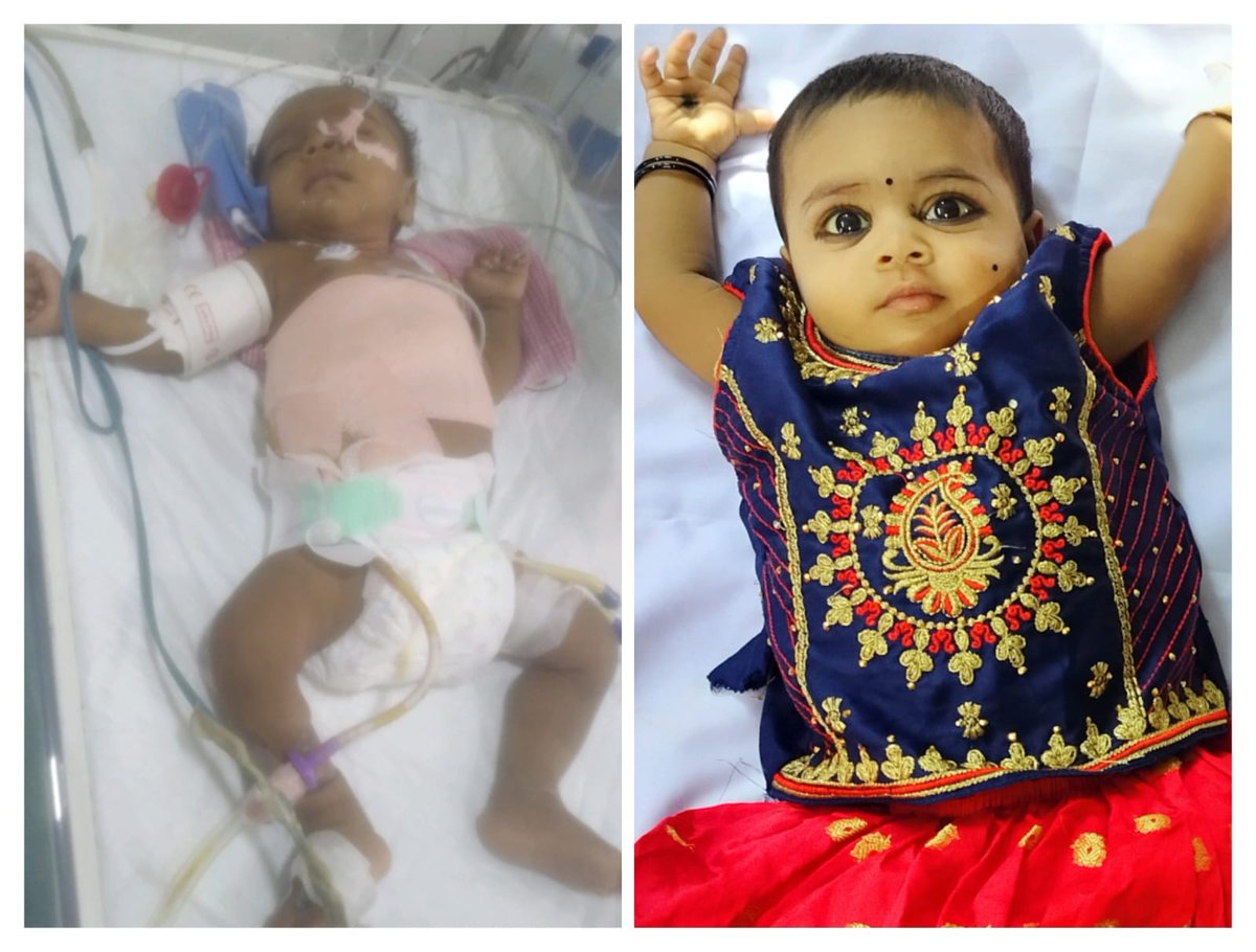 RavindraMandap2's tweet photo. @KTRTRS  ఖమ్మం జిల్లా సత్తుపల్లి లోని NTR నగర్, రెపాని పూర్ణ చంద్రరావు, లక్ష్మి ల కుమార్తె కుంధనిక Biliary Atresia అనే అరుదైన వ్యాధితో భాదపడుతూ చెన్నై లోని Rela Hospital లో చికిస్త పొందుతుంది. డాక్టర్లు లివర్ మార్పిడి చేయాలి. 22 లక్షలు ఖర్చు అవుతుంది అని చెప్పారు.Pls help sir. https://t.co/eJPFZAHRpj