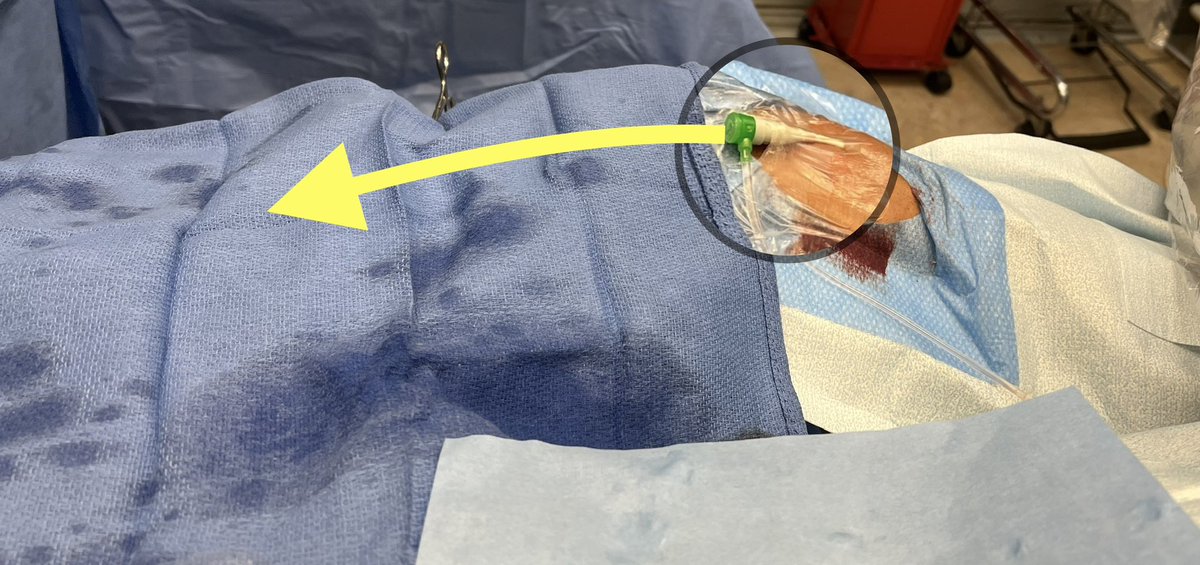 Tesslagra's tweet image. MINI #cathlabhack. 
For RRA slightly withdraw sheath &amp;amp; angle towards body &amp;amp; secure w tegaderm . Keeps catheter moving towards pt table. This gives more surface area 2work on. 🔴arrow is conventional angle laterally, 🟡arrow shows augmented catheter pathway 4better ergonomics.