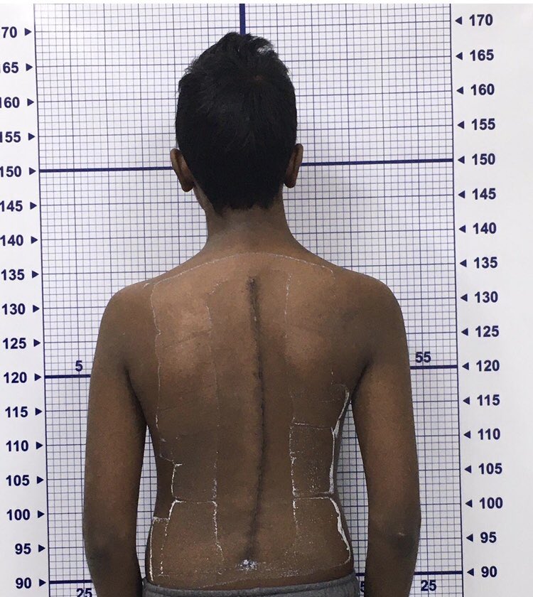 Scoliosis Surgery to correct a bent spine in a school boy. Partly funded by Scoliosis Foundation of India. #scoliosis #scoliosisfoundationofindia #scoliosissurgery #scoliosissurgeon