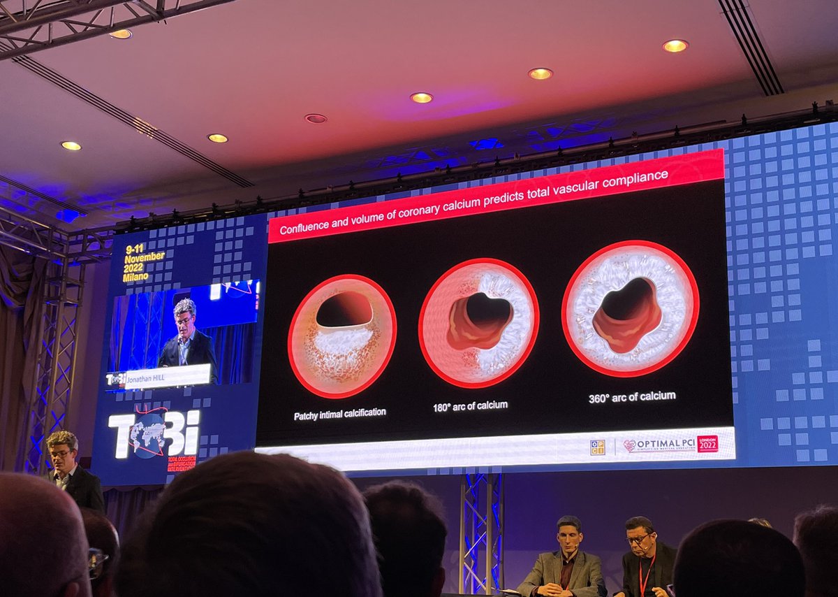 Umberto Barbero (@barberoumberto) on Twitter photo “Balloon expansion doesn’t mean plaque modification”
Calcium wisdom by <a href="/DrJMHill/">Jonathan Hill</a> at <a href="/tobicongress/">TOBI Total Occlusion Bifurcation Interventions</a> from RBHH <a href="/RBandH/">Royal Brompton and Harefield</a> “Balloon expansion doesn’t mean plaque modification”
Calcium wisdom by <a href="/DrJMHill/">Jonathan Hill</a> at <a href="/tobicongress/">TOBI Total Occlusion Bifurcation Interventions</a> from RBHH <a href="/RBandH/">Royal Brompton and Harefield</a>