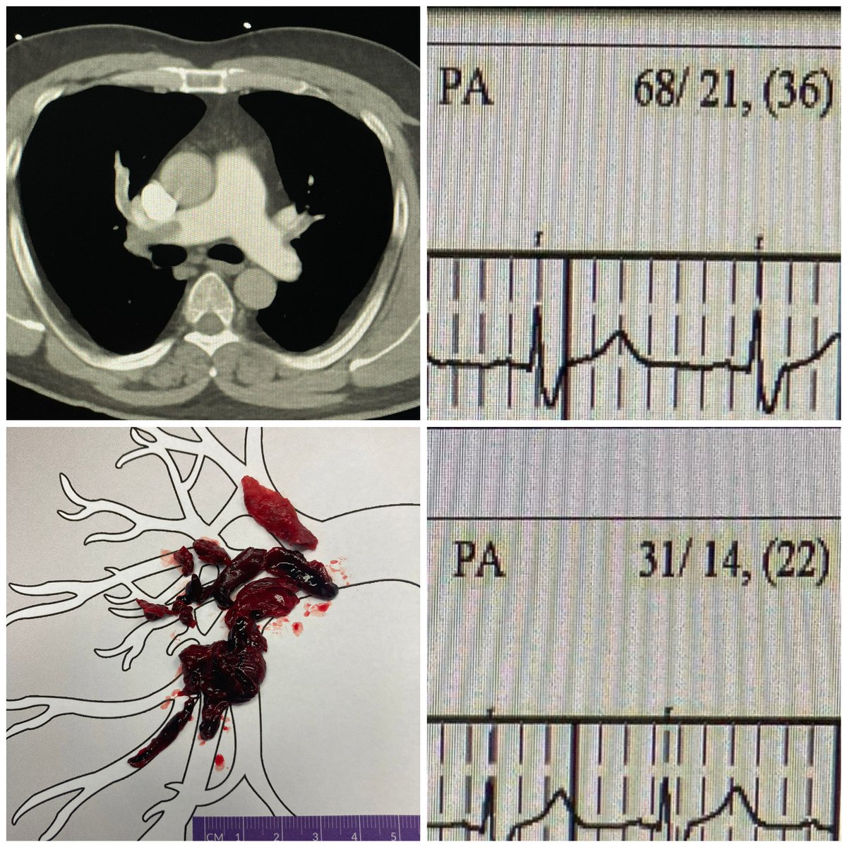 Daniel Messiha, MD (@realdocdan) on Twitter photo It’s #PERT time! Interventionell thrombectomy of right pulmonary artery in a pt w/ acute pulmonary embolism (PESI 120) performed by <a href="/RammosChristos/">Christos Rammos</a> & <a href="/alrashidfadi/">Fadi Al-Rashid</a> today. Impressive drop in sysPAP from 68 mmHg to 31 mmHg during procedure. #CardioTwitter #FOAMed #MedTwitter It’s #PERT time! Interventionell thrombectomy of right pulmonary artery in a pt w/ acute pulmonary embolism (PESI 120) performed by <a href="/RammosChristos/">Christos Rammos</a> & <a href="/alrashidfadi/">Fadi Al-Rashid</a> today. Impressive drop in sysPAP from 68 mmHg to 31 mmHg during procedure. #CardioTwitter #FOAMed #MedTwitter