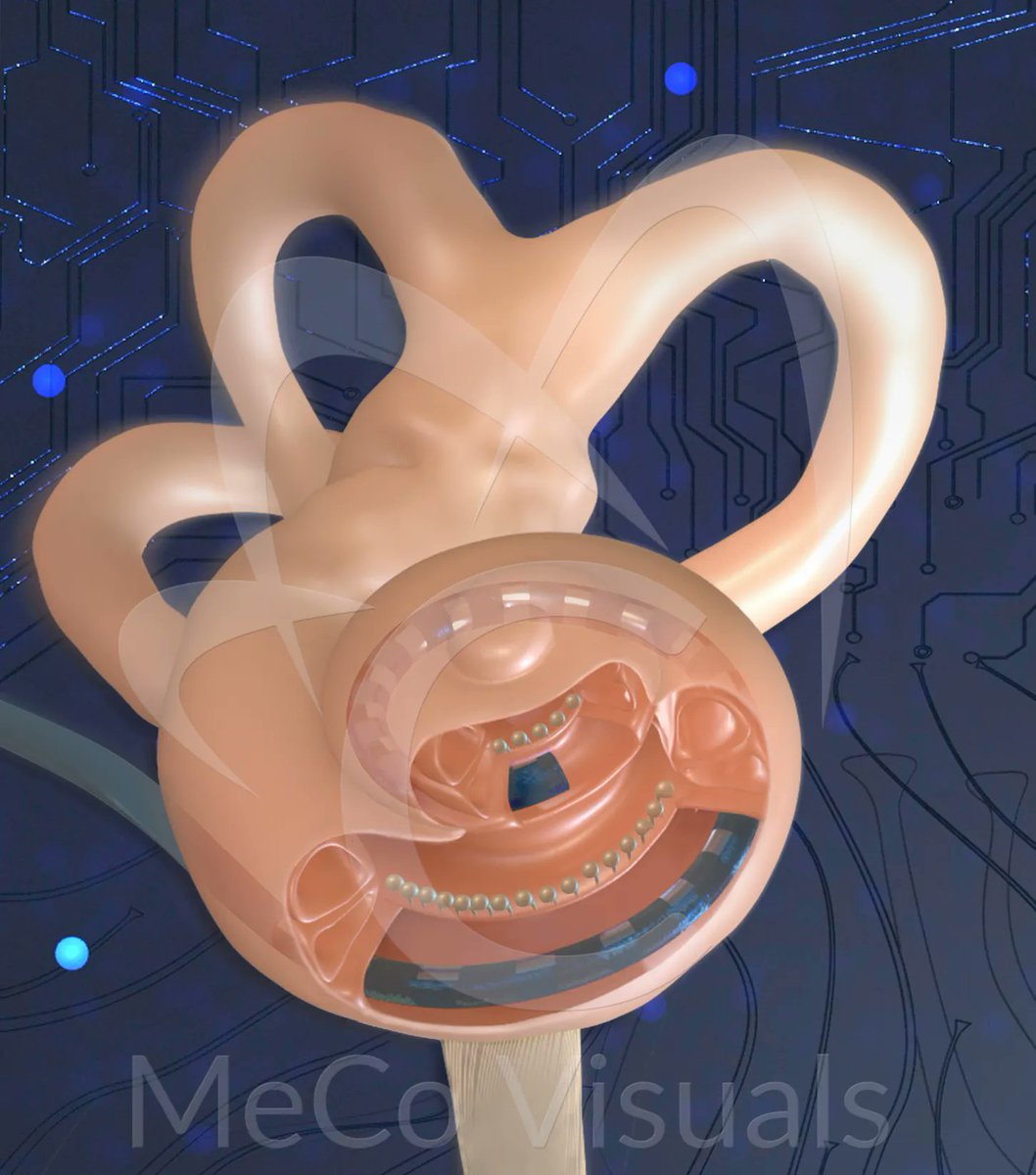 Medical Illustration & Animation (@medillustrates) on Twitter photo Cochlear Implant Mechanism, illustrated by Gerrity | Connolly <a href="/ChiMedGraphics/">Chicago Med Graphics</a>.
Explore more by Chicago Medical Graphics: buff.ly/2OQJ8vi
#cochlearimplant #northwestern #biotech #medical #illustration #medicalillustration #scientificillustration #3D #sciart #science Cochlear Implant Mechanism, illustrated by Gerrity | Connolly <a href="/ChiMedGraphics/">Chicago Med Graphics</a>.
Explore more by Chicago Medical Graphics: buff.ly/2OQJ8vi
#cochlearimplant #northwestern #biotech #medical #illustration #medicalillustration #scientificillustration #3D #sciart #science