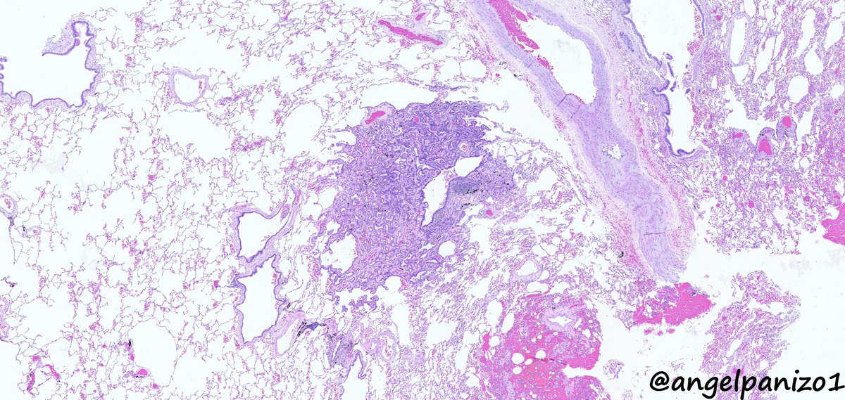angelpanizo1's tweet photo. Incidental finding in an upper lobectomy of the right lung for mucinous adenocarcinoma. Any suggestion? (1) #pulmpath #surgpath @smlungpathguy @yro854 @SansanoValero @natasharekhtman @MelanieBoisMD https://t.co/8a0nsEKxMI