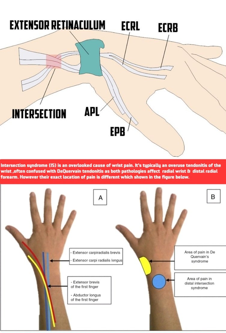 𝐃𝐫.𝐎𝐌𝐈𝐃 𝐁𝐀𝐍𝐃𝐀𝐑𝐂𝐇𝐈, 𝐌.𝐃. on Twitter "INTERSECTION SYNDROME Proximal IS represents classical