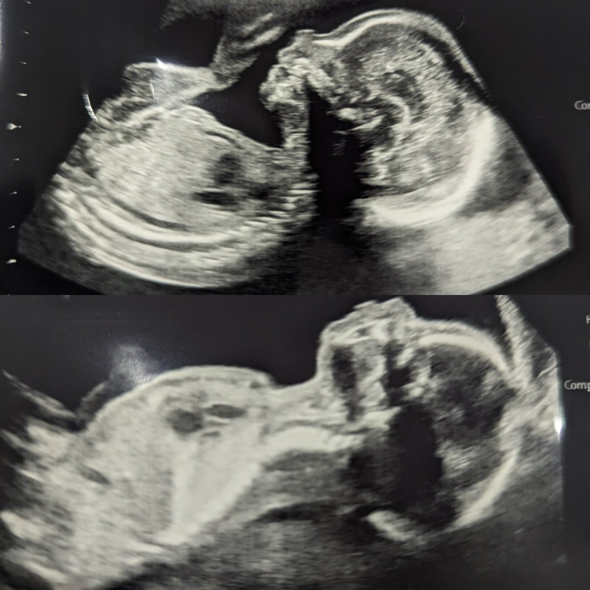 JadeDenby's tweet photo. Very surreal every time I go for a scan to think there's a tiny human being inside there. Halfway there at 20 weeks. Should probably start buying baby things! All advice from parents welcomed 😂 #babyontheway #clueless https://t.co/mZpL9OYhcS