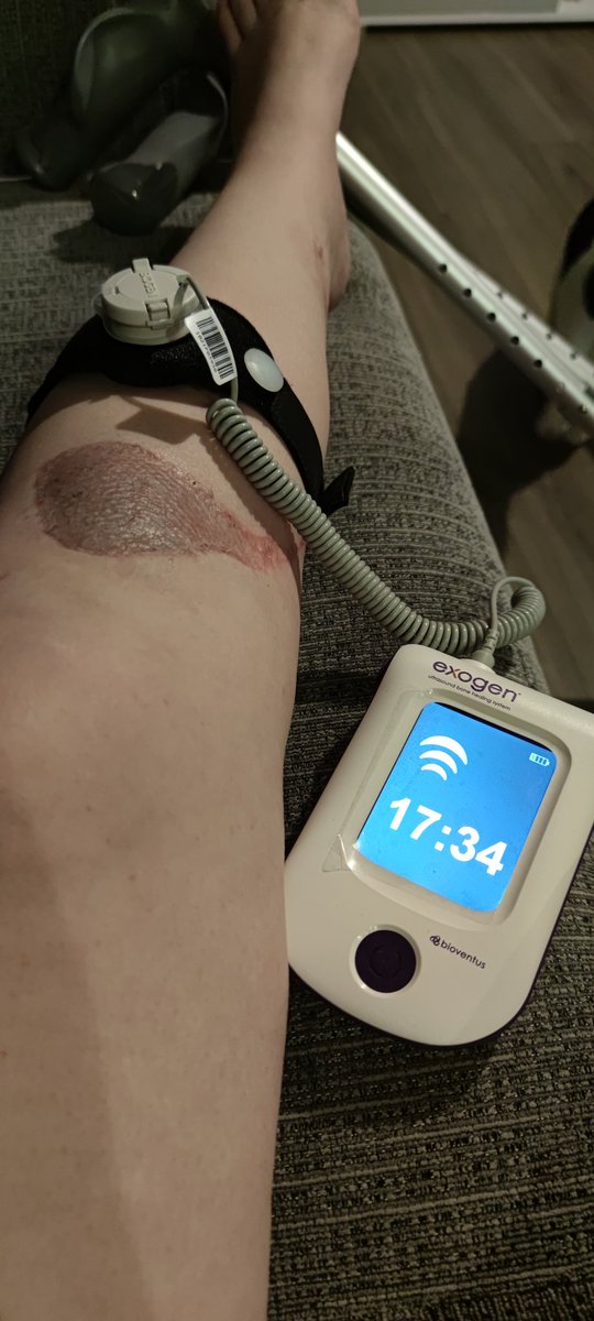 TopazD_'s tweet photo. First Exogen treatment this evening for my delayed healing tibia! 
Pics: day of injury &amp; 16w post surgery! 
Feeling optimistic 🤞🏻
I need to get back to work/uni ☢️

#openfracture #delayedunion #exogen #radapprentice #radiology https://t.co/bjqE45MN2F