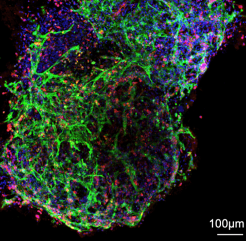 ElizSMcKenna's tweet image. Now in @CD_AACR: Human #BoneMarrow #Organoids for Disease Modelling, Discovery &amp;amp; Validation of Therapeutic Targets in Hematological Malignancies by Abdullah Khan @theclotthickens @beth_psaila et al. @unibirmingham @BostonChildrens @MRC_WIMM @UniofOxford aacrjournals.org/cancerdiscover…