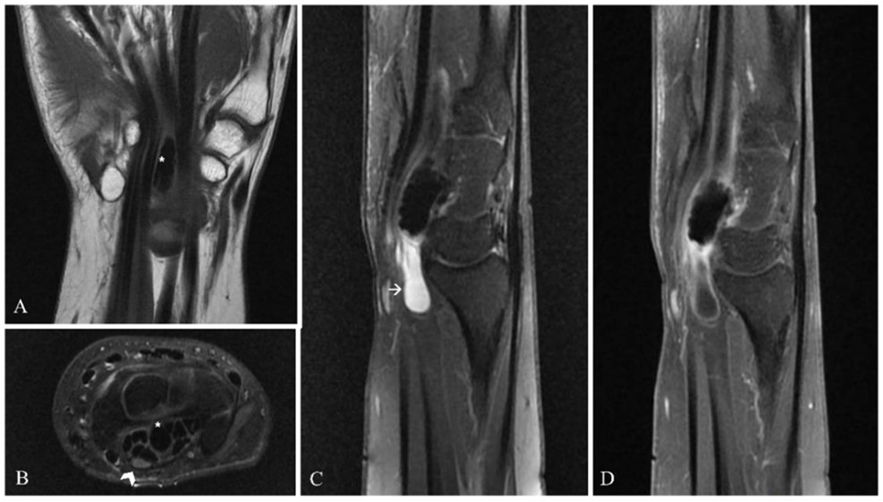 ESanayeh's tweet photo. Happy to share our new publication in the #BMC #musculoskeletal disorders: "Carpal tunnel syndrome secondary to tumoral calcinosis: a case report and review of the literature". Physicians should always include this rare benign condition in their differential #diagnosis. https://t.co/idLokfnCsF