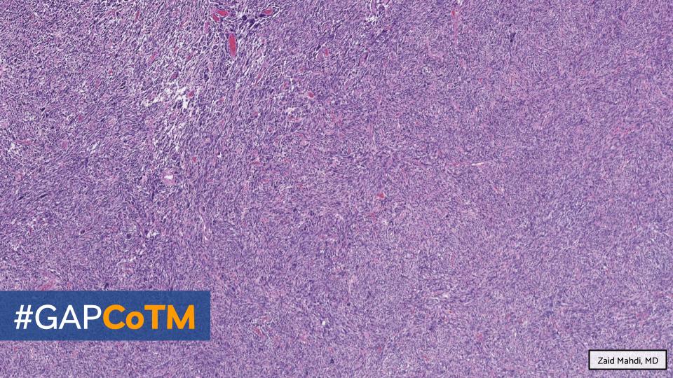GAPathologists's tweet photo. GAP CASE OF THE MONTH #15:
59βοΈ w/ recent cough & congestion. Imaging shows a large pleural-based lung mass.
By: Zaid Mahdi (@zaid_mahdi)
π¬ WSI: https://t.co/SAPfWyrJIK
π‘ Answer: https://t.co/hc53Jn5PRv
#GAPCoTM #lungpath #pulmpath #bstpath @EmoryPathology @AU_Pathology https://t.co/E4b0SPirn2