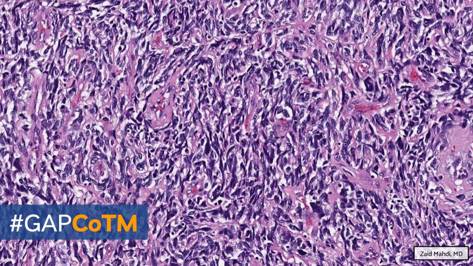 Georgia Association of Pathology (GAP) (@gapathologists) on Twitter photo GAP CASE OF THE MONTH #15:
59♂️ w/ recent cough & congestion. Imaging shows a large pleural-based lung mass.
By: Zaid Mahdi (<a href="/zaid_mahdi/">Zaid Mahdi</a>)
🔬 WSI: bit.ly/3DVkTFG
💡 Answer: bit.ly/3UJevIa
#GAPCoTM #lungpath #pulmpath #bstpath <a href="/EmoryPathology/">Emory University Department of Pathology</a> @AU_Pathology GAP CASE OF THE MONTH #15:
59♂️ w/ recent cough & congestion. Imaging shows a large pleural-based lung mass.
By: Zaid Mahdi (<a href="/zaid_mahdi/">Zaid Mahdi</a>)
🔬 WSI: bit.ly/3DVkTFG
💡 Answer: bit.ly/3UJevIa
#GAPCoTM #lungpath #pulmpath #bstpath <a href="/EmoryPathology/">Emory University Department of Pathology</a> @AU_Pathology