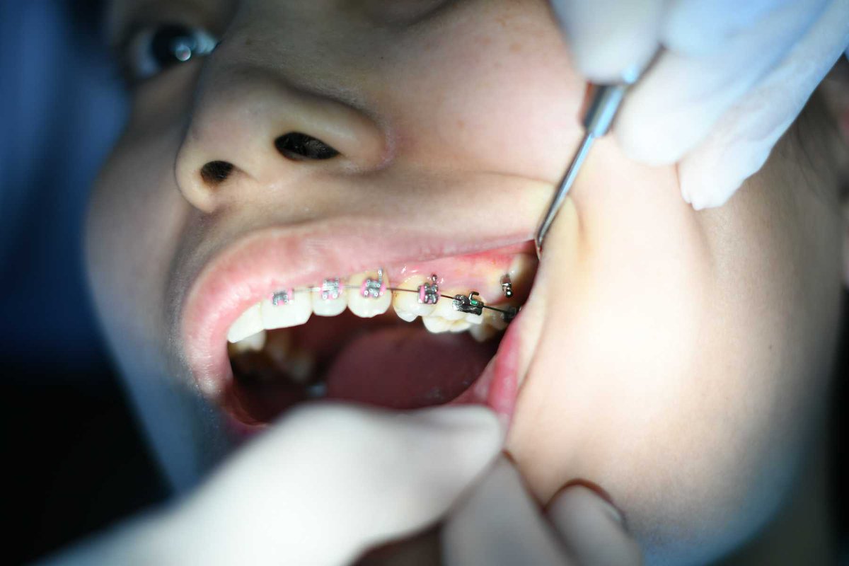 Most people believe crooked teeth are genetic. While that is partially true, bad habits also cause crooked teeth. Here are five reasons some people have misaligned teeth ow.ly/TVW650LzcWP