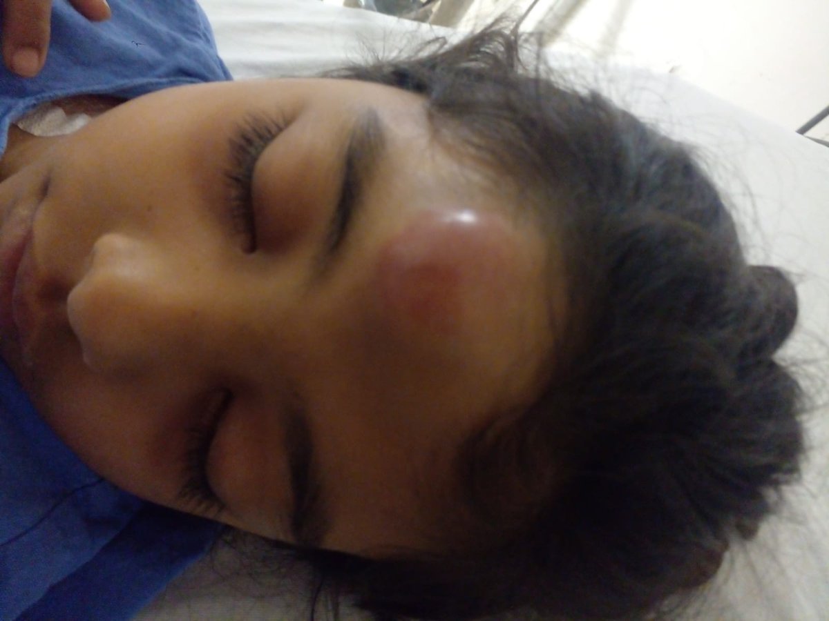 yohaliresendiz's tweet photo. Emily tiene 9 años. Comenzó con dolor de garganta y apareció este hematoma. Convulsionó. En el @ISSSTE_mx Zaragoza Pediatría no tiene cama, ni le han hecho estudios, está en grave, en riesgo @drpedrozenteno Esto no sana con paracetamol URGE LA ATIENDAN O SERÁ NEGLIGENCIA #Atenta https://t.co/u6E07Uecyi