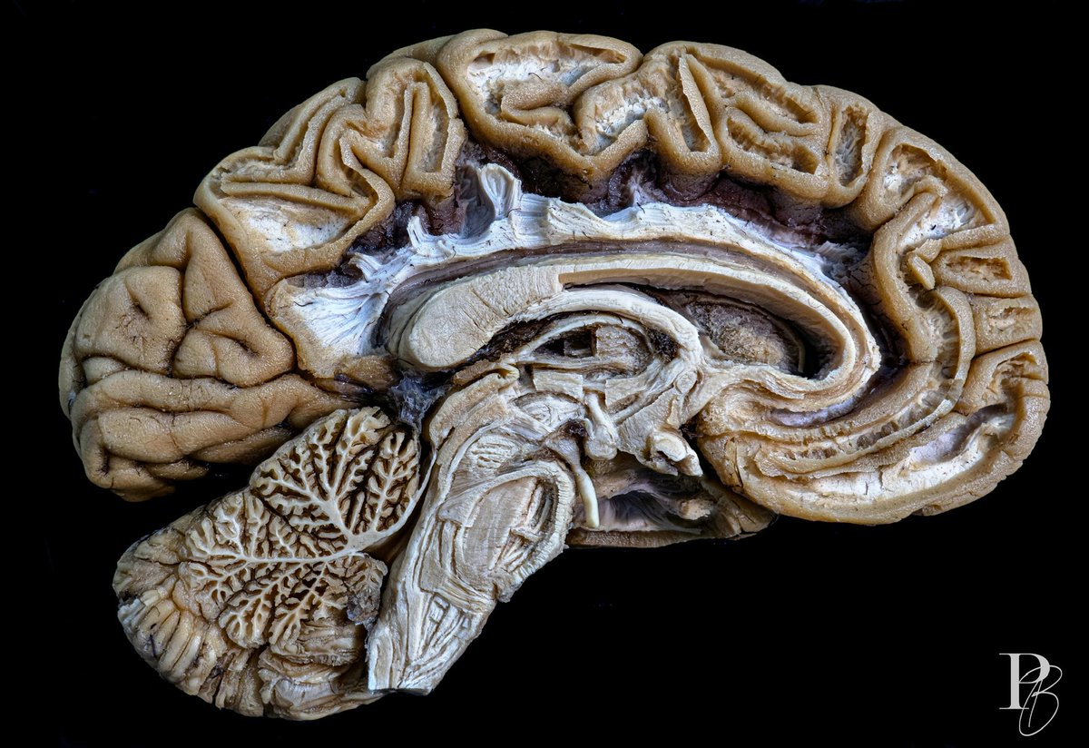 Daniel “Photobrain” Ballesteros (@photobrain_mx) on Twitter photo Después de muchas horas non-stop ayer. Acumulado de 15 horas en dos días se realizó este que para mi puede ser el photobrain más impactante para la vista. Disecado y fotografiado por <a href="/photobrain_mx/">Daniel “Photobrain” Ballesteros</a>. En de la segunda cátedra de anatomía. Gracias totales. #neuro #neuroanatomy Después de muchas horas non-stop ayer. Acumulado de 15 horas en dos días se realizó este que para mi puede ser el photobrain más impactante para la vista. Disecado y fotografiado por <a href="/photobrain_mx/">Daniel “Photobrain” Ballesteros</a>. En de la segunda cátedra de anatomía. Gracias totales. #neuro #neuroanatomy
