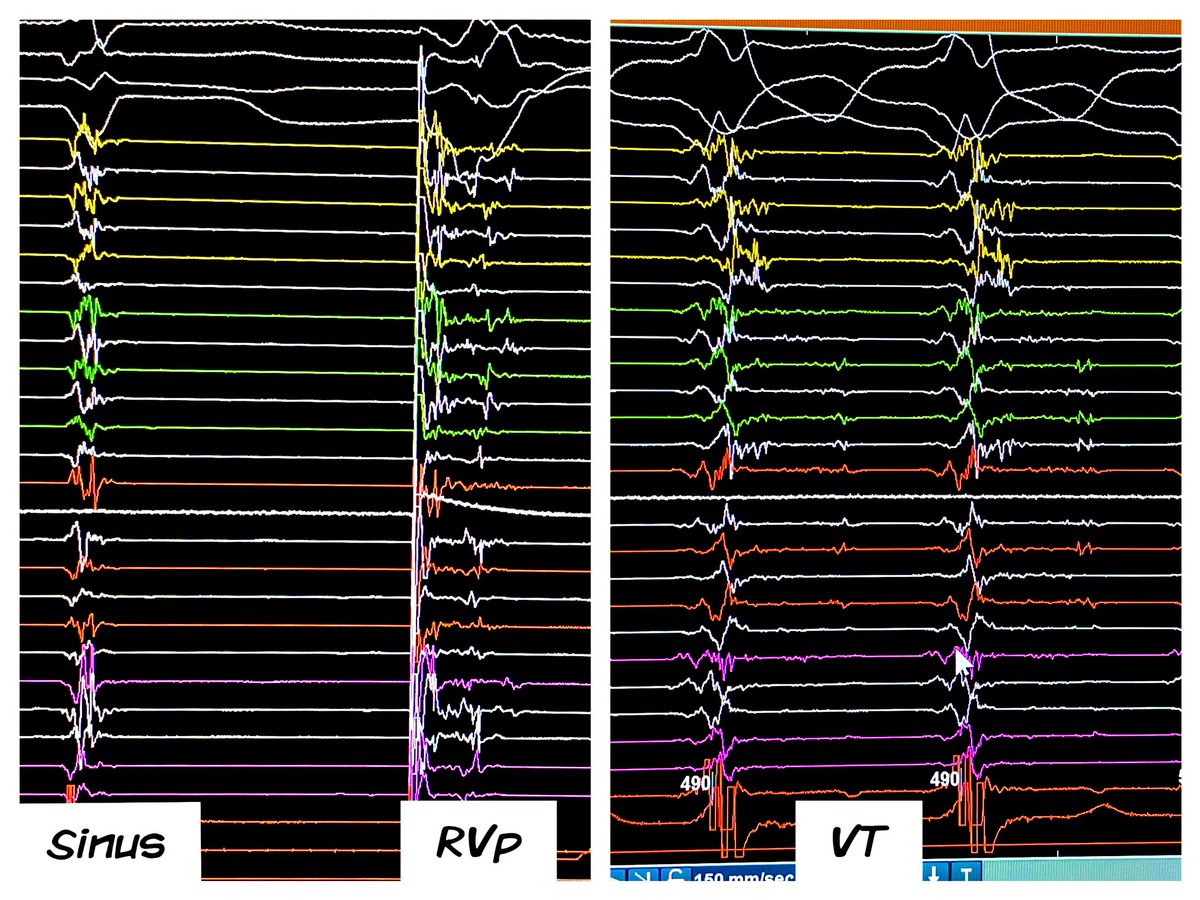 EhdaieMd's tweet photo. If you’re not test driving #EGMs you’re missing out on some serious 💎 🎯 

Ridiculous wavefront 🌊 slowing w/ RV pacing corresponding to critical diastolic EGMs during VT

Dynamic Maps >> Static Maps #AblateVT https://t.co/LofP5cBsOX