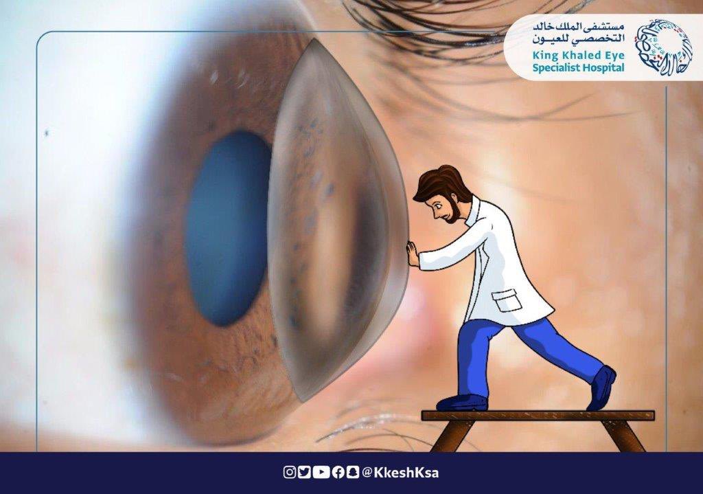 KKESHKSA's tweet photo. شاركونا تعليقاتكم على الصورة..
#يوم_القرنية_المخروطية_العالمي
#القرنية_المخروطية
#WorldKCDay
#KCConfidence
#LivingWithKC https://t.co/HJuSxnzkxn
