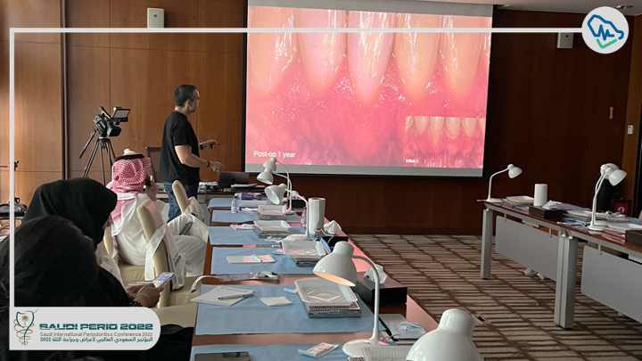 saudiperio's tweet photo. 🚩#HAPPENING_NOW : 

 Dr. Olivier Carcuac 

“The Modified Free Gingival Graft – An Innovative Approach For Treatment Of Gingival Recession Defect At Lower Anterior Teeth” 

 #SaudiPerio2022 https://t.co/D6eJsZoVof