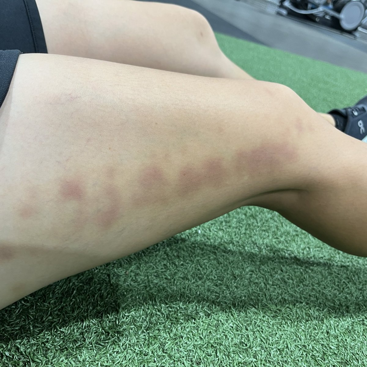 hien83's tweet photo. Ultimate and my body have a love-hate relationship. Getting PT to work out some old and new problems. #astym #tendinosis #patellartracking https://t.co/ZI5G2xUGJK