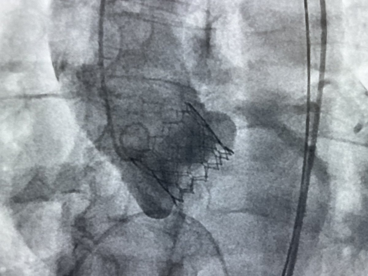 Ditongaje's tweet image. 71 female severe AS, mod severe AR. #tavi #tavr with Sapiens S3 26mm. AR Index from 17 to 35. Hemodynamic pre peak to peak gradient of 80 with wide pulse pressure and narrow diastolic gradient. #structuralintervention #apsic #CardioTwitter