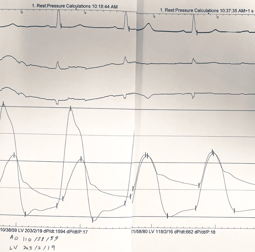 Ditongaje's tweet image. 71 female severe AS, mod severe AR. #tavi #tavr with Sapiens S3 26mm. AR Index from 17 to 35. Hemodynamic pre peak to peak gradient of 80 with wide pulse pressure and narrow diastolic gradient. #structuralintervention #apsic #CardioTwitter