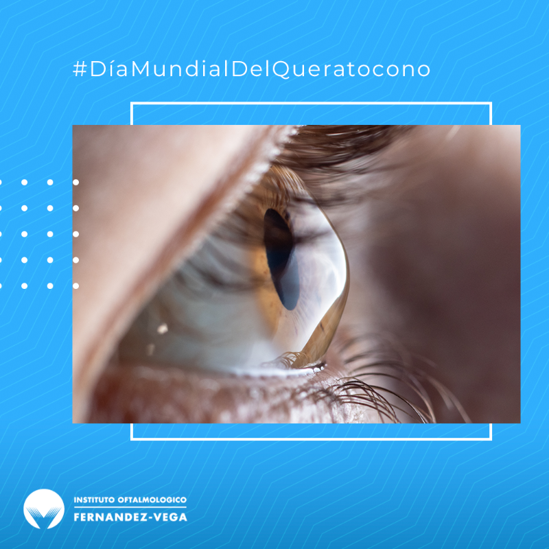 IOFVega's tweet photo. Hoy nos unimos al #DíaMundialDelQueratocono, una enfermedad inflamatoria y progresiva de la #córnea que suele aparecer en la infancia y la adolescencia. Aunque existen otros factores, está relacionado con la atopia y el frotamiento ocular intenso. ¡Más info en nuestro #BlogFV! 👇