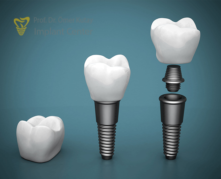 İmplant Nasıl Yapılır
İmplant Nasıl Yapılır? Dişlerinde problem yaşayan ancak takma diş gibi geleneksel çözümleri tercih etmeyen, bir türlü karar 
omerkutay.com/implant-nasil-…
#implant #implantdiş #implantdiştedavisi #implantnasılyapılır #implantyapımı #implantnasıltakılır #ömerkutay