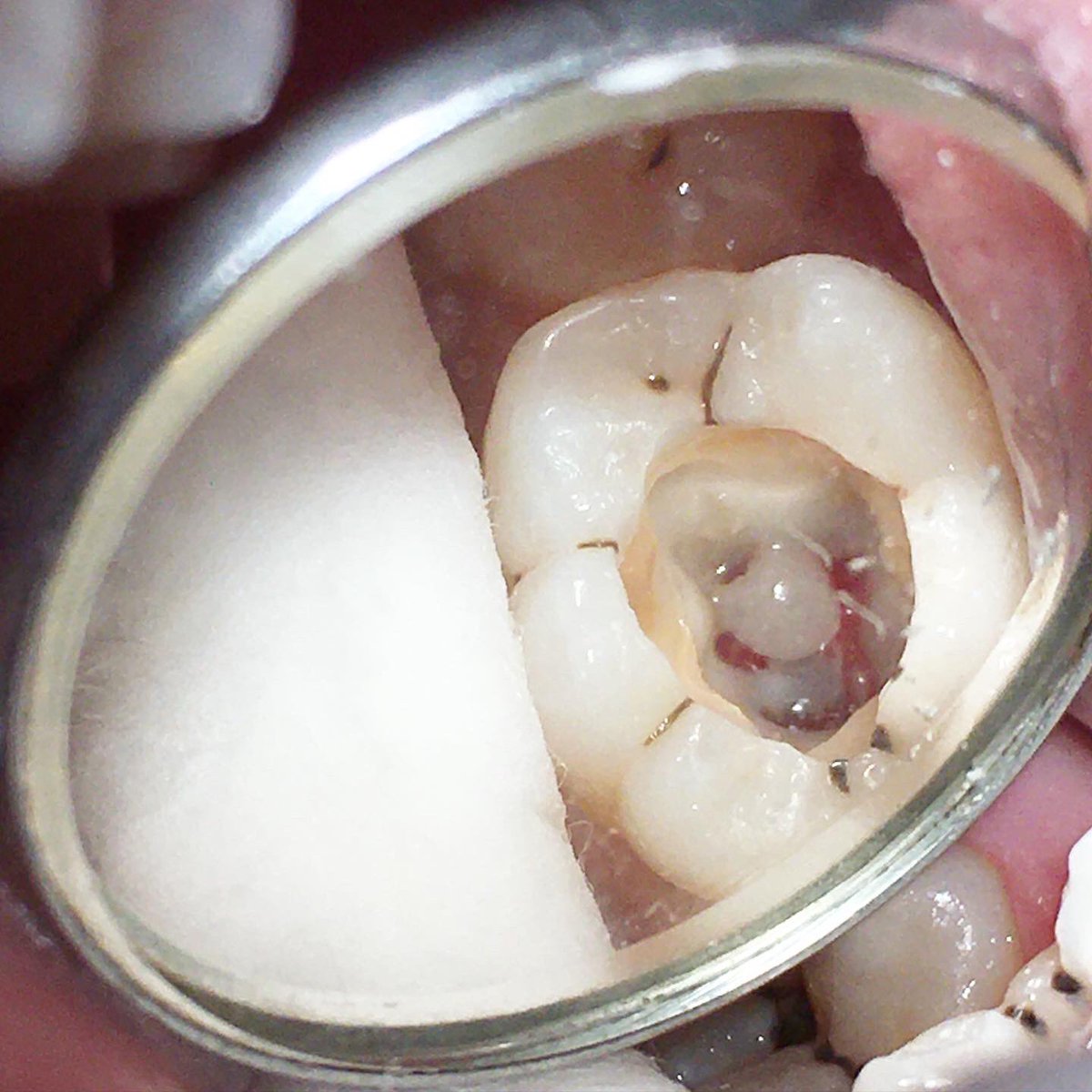 DrMuii_MDIB's tweet image. Pulp stone atau batu pulpa di gigi adalah kalsifikasi yang ditemukan di ruang pulpa atau saluran akar gigi.

#pulpstone #removepulpstone #beforeandafter #doktergigimedan #medandentalspecialistcenter #doktergigispesialismedan #klinikgigimedan #perawatangigimedan #medantourism