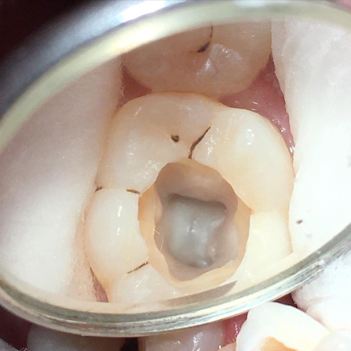 DrMuii_MDIB's tweet image. Pulp stone atau batu pulpa di gigi adalah kalsifikasi yang ditemukan di ruang pulpa atau saluran akar gigi.

#pulpstone #removepulpstone #beforeandafter #doktergigimedan #medandentalspecialistcenter #doktergigispesialismedan #klinikgigimedan #perawatangigimedan #medantourism