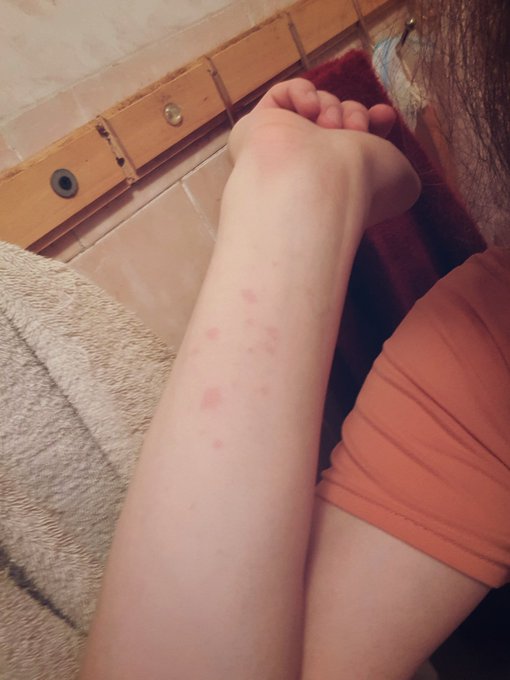 1 pic. When I was making chips again, the oil burned my hand :< https://t.co/PTVYfDQhvP