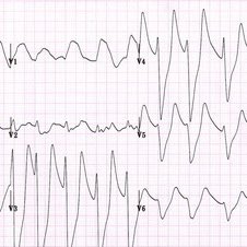 EKG shows sine-wave pattern arrhythmia, which can be seen in severe hyperkalemia