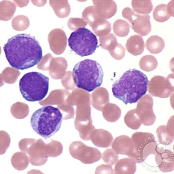 Peripheral smear shows many blasts- later diagnosed with acute lymphoblastic leukemia